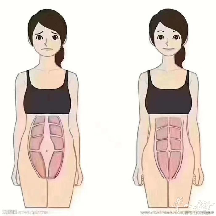 【腹直肌分离】
生完孩子经常腰酸背痛，很多宝妈还以为是带娃累的，其实还有腹直肌分