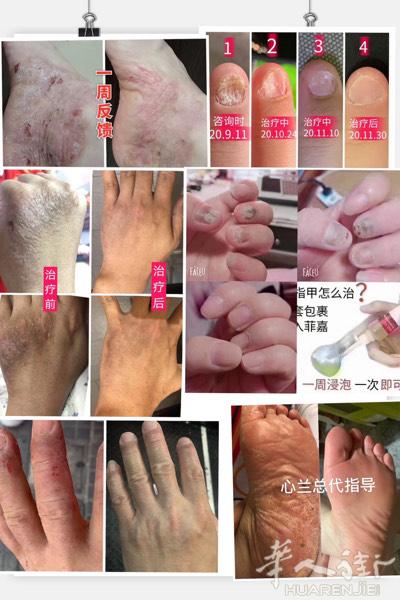 有脚气 灰指甲 等困扰 欢迎大家关注微信公众号
美