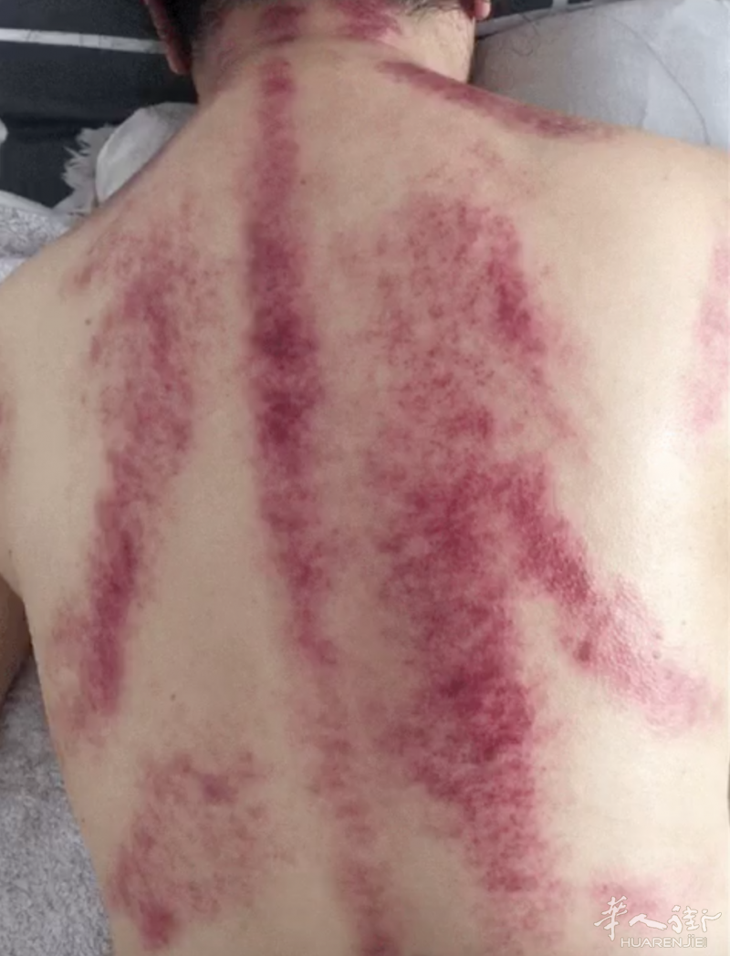 中医王师傅、女,具有18年的经验,按摩推拿对于头晕,失眠,头痛,颈椎病,肩周炎,风湿性腰腿痛,